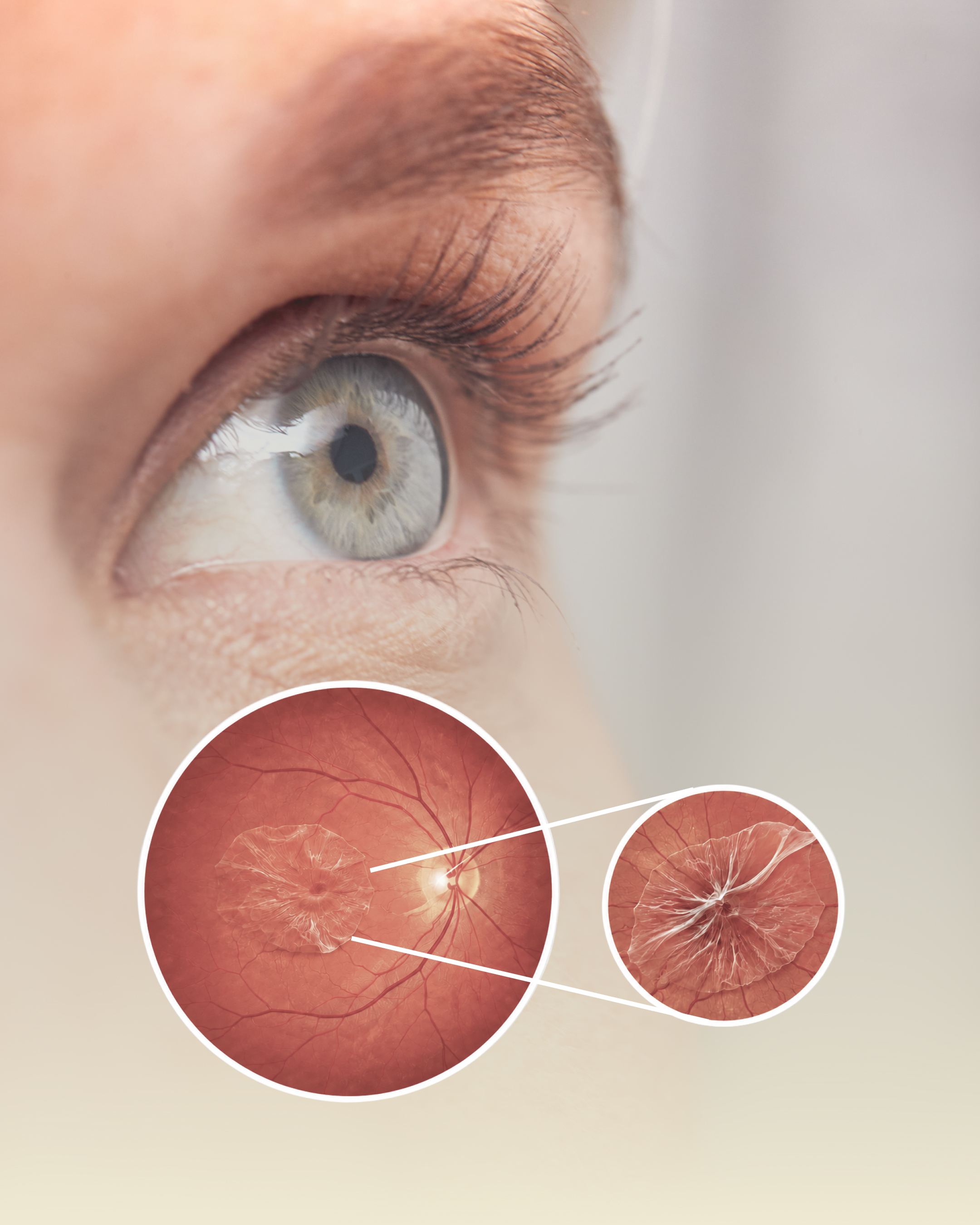 Consultant-led epiretinal membrane removal surgery at The Eye Doctor Clinic in Huddersfield